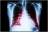 Radiographie thoracique montrant une insuffisance cardiaque (illustration).