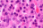Histologiquement, le myélome multiple est un plasmocytome (illustration @ Nephron, sur Wikimedia).