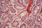 Vue au microscope de tissu pulmonaire humain avec une embolie pulmonaire (illustration).