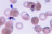 Frottis sanguin révélant la présence du parasite Plasmodium falciparum ayant la forme d'anneaux à l'intérieur d'hématies humaines (cliché @ TimVickers, Wikimedia).