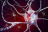 Représentation en 3D de corps de Lewy accumulés dans les cellules du cerveau, dont ils provoquent la dégénérescence progressive (illustration).