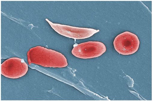 Globule rouge falciforme (pâle, en haut), typique de la drépanocytose (illustration @OpenStax College - Anatomy & Physiology, sur Wikimedia)