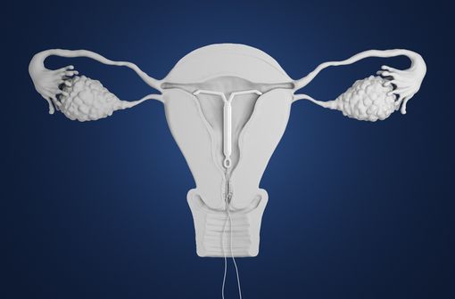 Représentation en 3D d'un stérilet en place dans la cavité utérine (illustration).
