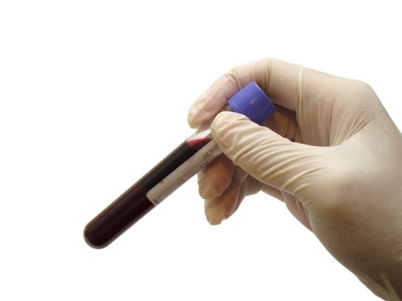 Il n\'existe pas de moyen de mesurer en pratique courante le degré d\'anticoagulation que les NACO produisent.