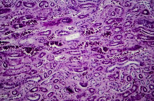 Photo au microscope d’une glomérulonéphrite proliférative diffuse (illustration).