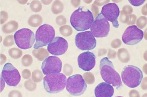 Frottis d'aspiration de moelle osseuse coloré par le test de Wright d'un patient atteint de leucémie lymphoblastique aiguë à cellules B précurseurs (illustration @VashiDonsk sur Wikimédia).