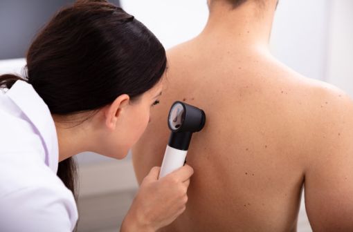 Le mélanome est un cancer cutané à fort potentiel métastatique, lié à la transformation maligne de cellules pigmentaires de la peau, les mélanocytes (illustration).