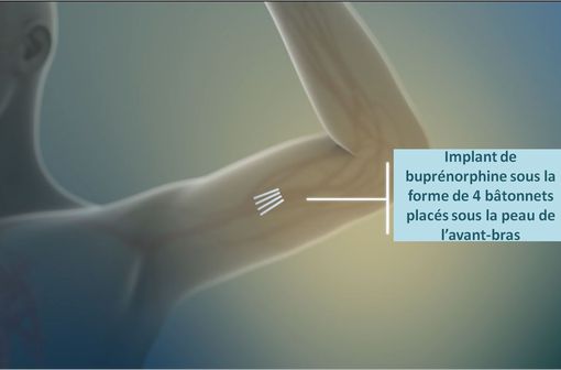 Capture d'écran d'une animation montrant le positionnement d'un implant de buprénorphine (Probuphine). 