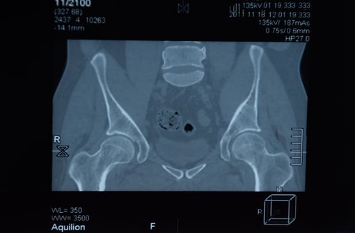 IRM des articulations sacro-iliaques d’un patient souffrant de spondylarthrite ankylosante (illustration).