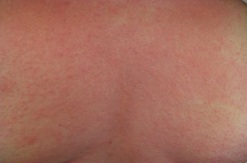 Éruption de type allergique accompagnant souvent le début d'un choc anaphylactique (illustration @James Heilman, MD, sur Wikimedia).