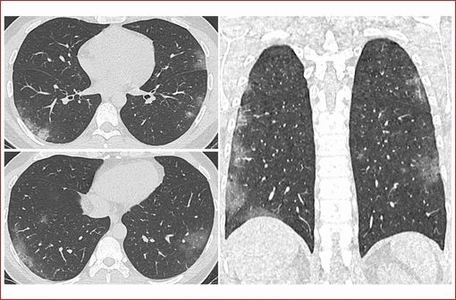 Aspect typique de pneumopathie COVID-19 sous la forme de plages de verre dépoli bilatérales multifocales, à prédominance sous-pleurale et postérieure (illustration). 