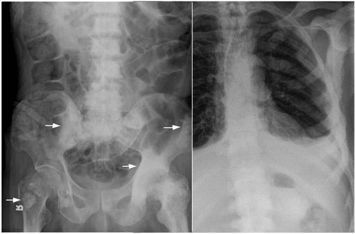 Métastases osseuses chez des patients atteints d'un cancer de la prostate (clichés @ Wikimedia).