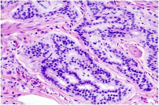Vue histopathologique de cellules cancéreuses du colon (photo @ GNU Free Documentation License, sur Wikimedia).