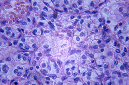 Carcinome rénal (coupe histologique en vue microscopique)