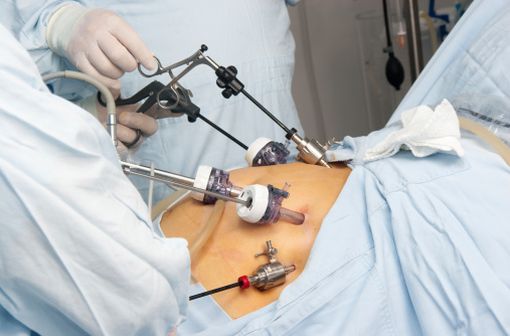 Chirurgie bariatrique : réalisation d'un bypass (illustration).