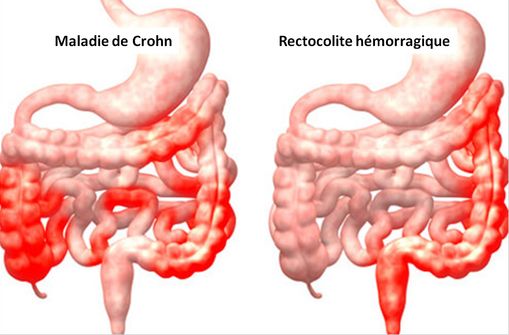 Les atteintes diffuses liée à la maladie de Crohn sont diffuses, alors que celles de la RCH concernent la partie distale du tube digestif (illustration, © OnHealth).