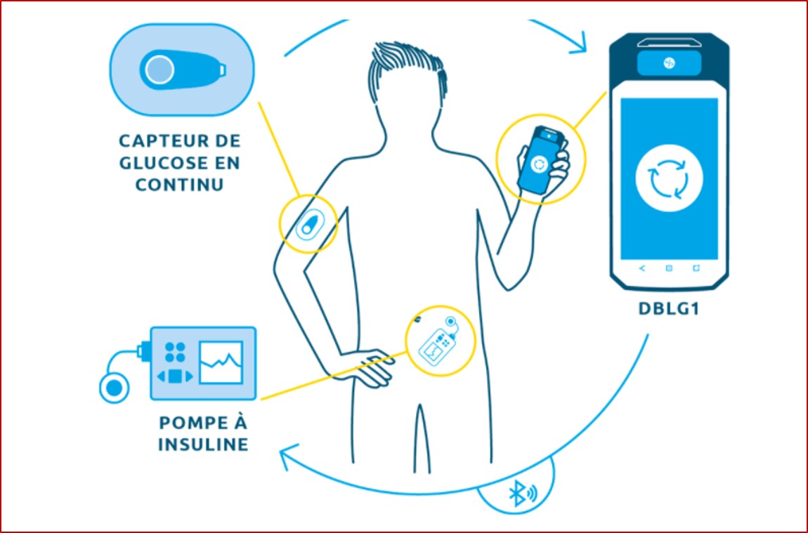 L’algorithme DBLG1 développé par Diabeloop est hébergé dans un terminal dédié qui sert d’interface utilisateur avec le système, associé avec un capteur de glucose en continu (CGM) et une pompe à insuline (illustration @Diabeloop).