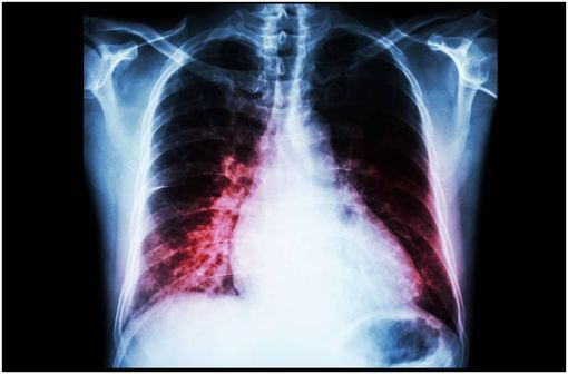 Radiographie thoracique montrant une insuffisance cardiaque (illustration).