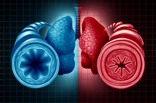 Représentation en 3D de coupes transversales de bronches, l'une normale (en bleu), l'autre en bronchoconstriction (en rouge) [illustration]