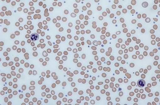 Frottis sanguin d'une personne souffrant d'anémie ferriprive avec des globules rouges petits et pâles (illustration @Dr Graham Beards, sur Wikimedia).