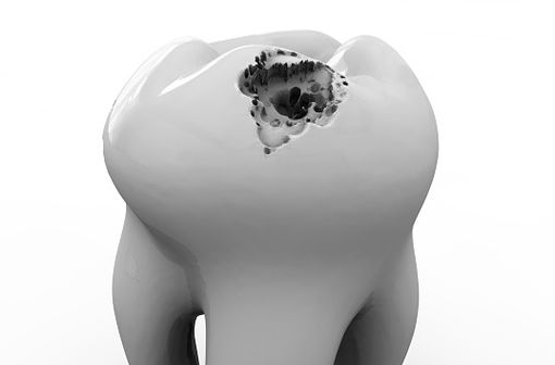 La carie dentaire est une affection de la dent, qui subit une altération de l'émail puis de la dentine, et entraîne la formation de cavités au sein de la dent et sa destruction progressive (illustration).