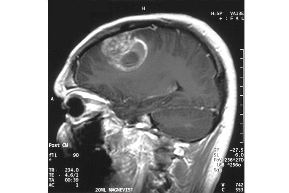 Glioblastome multiforme chez un enfant de 15 ans. IRM cérébrale avec injection de produit de contraste (© Christaras A, Wikimedia).