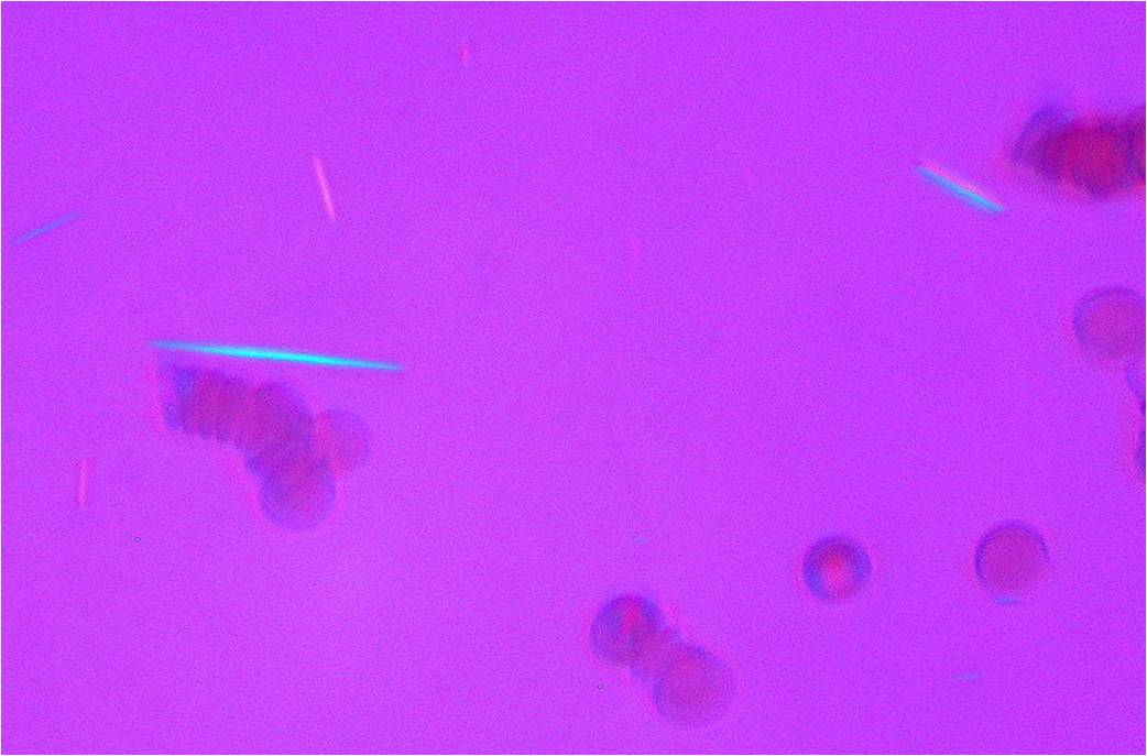 Cristaux d'urate dans du liquide synovial (© Ed Uthman, Wikimedia)