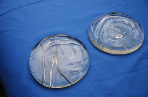 Implants mammaires (illustration).