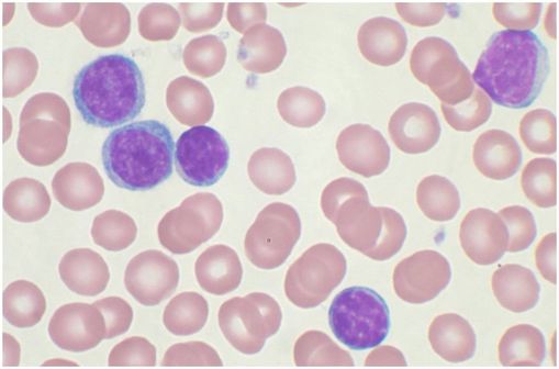 Lymphocytes B (cytoplasme bleu et noyau violet) lors d'une leucémie lymphoïde chronique observés sur sang périphérique (cliché @ Mary Ann Thompson sur Wikimedia).
