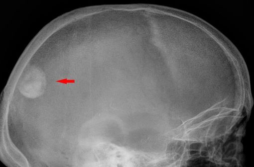 Méningiome sur une radiographie du crâne (illustration @Hellerhoff - Eigenes Werk sur Wikimedia).