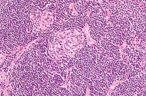 La maladie de Castleman est un trouble lymphoprolifératif rare qui peut être localisée à un seul ganglion lymphatique (monocentrique) ou être systémique (multicentrique). Photo © WIKIPEDIA