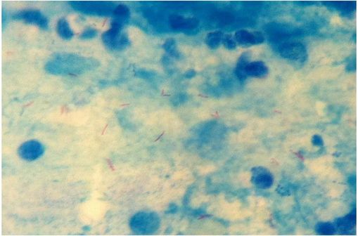 Mycobacterium tuberculosis colorés en rouge dans les expectorations d'un patient infecté (coloration Ziehl-Nielsen) (cliché @ Usainfail sur Wikimedia).