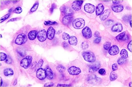 Coupe histologique d'un carcinome papillaire de la thyroïde (illustration @Wikimedia).
