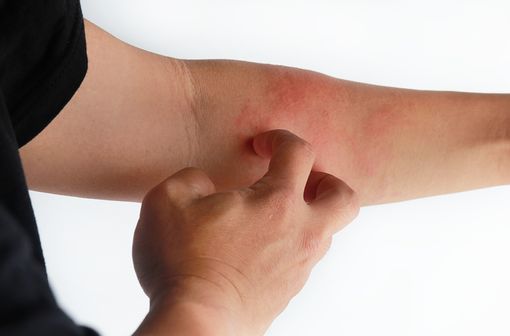 La dermatite atopique de l’adulte se manifeste, dans sa forme chronique, par des lésions cutanées érythémateuses d’étendue et d’intensité variables (illustration).