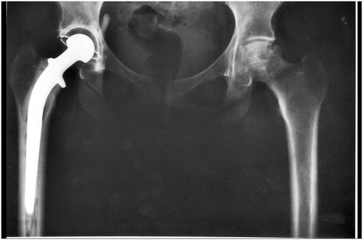 Radiographie d'une prothèse de hanche droite (illustration @NIADDK - 9AO4, NIH, sur Wikimedia).