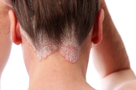 Psoriasis du cuir chevelu et de la lisière capillaire.