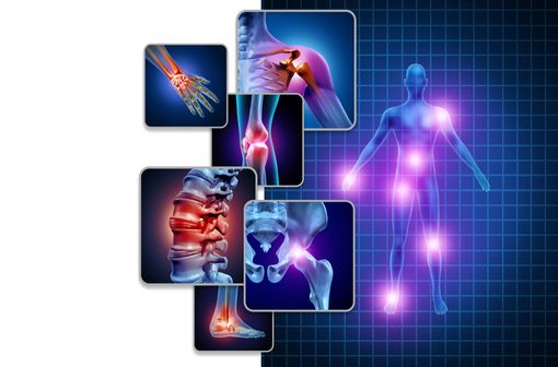 Les spondyloarthrites sont des rhumatismes inflammatoires partageant des caractéristiques communes comme des facteurs génétiques et l'atteinte privilégiée des enthèses (illustration).