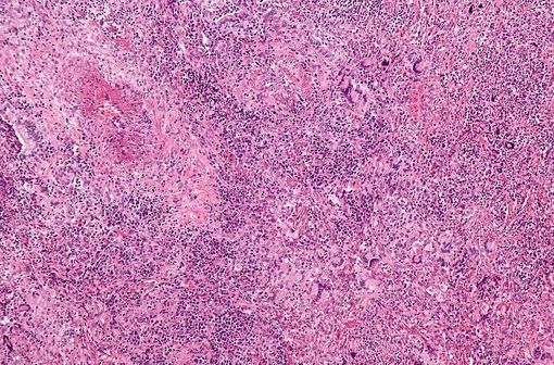 Coupe histologique caractéristique d’une granulomatose de Wegener : vascularite et granulomes accompagnés de cellules géantes polynucléées. Coloration H&E (illustration @Nephron sur Wikimedia).
