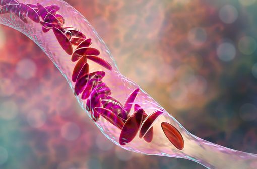 Représentation en 3D au sein d'un vaisseau d'hématies falciformes typiques de la drépanocytose (illustration).