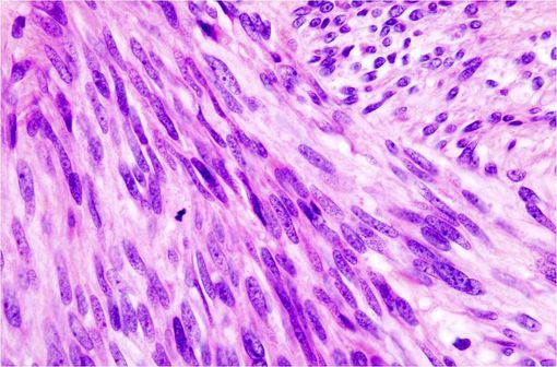 Image histopathologique d'une tumeur stromale gastro-intestinale de l'estomac (illustration @Wikimedia).