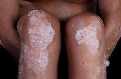 Lésions de psoriasis (illustration).