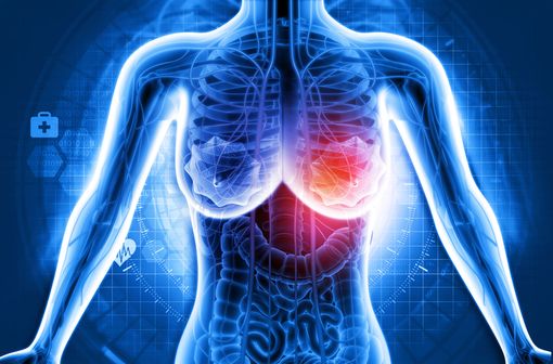 Le principal objectif recherché dans la prise en charge du cancer du sein avancé est une amélioration cliniquement significative de la survie globale des patientes, tout en maintenant ou en améliorant leur qualité de vie (illustration).