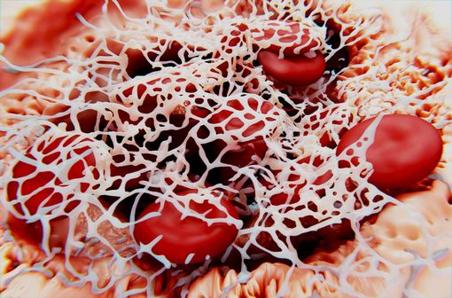 Représentation en 3D d'un caillot sanguin, où les globules rouges sont enserrés dans un maillage de fibrine (illustration).