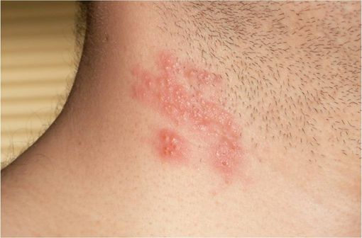 Lésions typiques de zona cervical (illustration @Wikimedia).