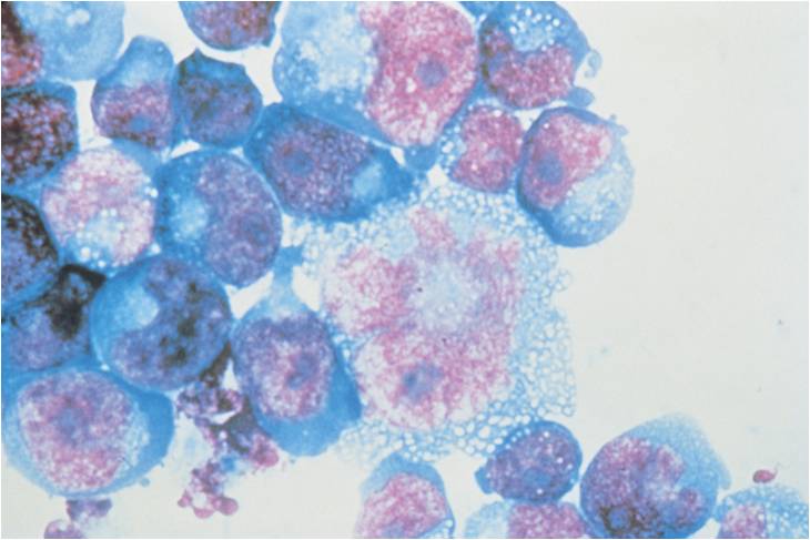 Cellules T infectées par le VIH.