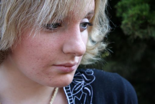 DIANE 35 devrait bientôt être à nouveau disponible en France pour les jeunes filles ou femmes ayant une acné modérée à sévère résistante aux traitements de première intention (en l'absence de facteurs de risque thrombo-emboliques).