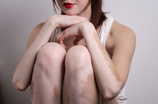 Une meilleure connaissance du vitiligo permet d'envisager des traitements plus efficaces (illustration).